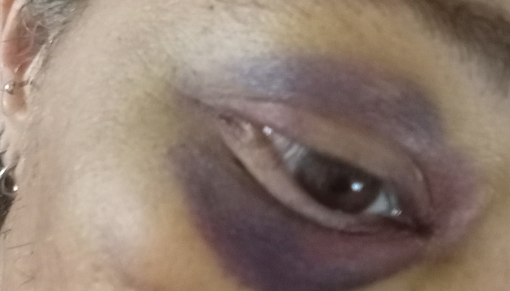 Close-up of a person's eye with severe purple and yellow bruising surrounding it.