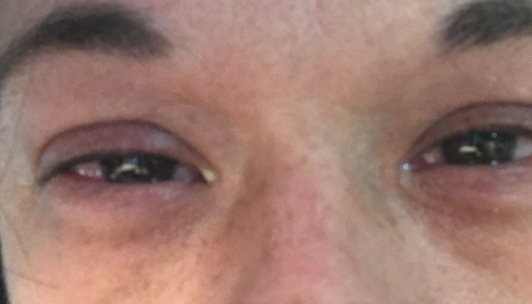 Close-up of a person with severely swollen, red, and irritated eyes.