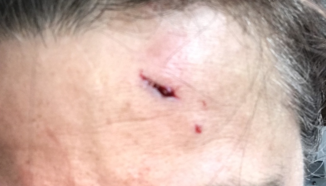 Close-up of a small, open laceration on a person's forehead near the hairline.
