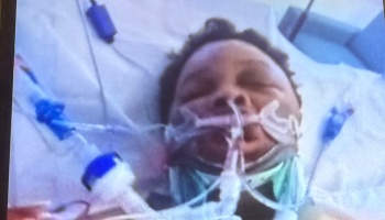 A patient lying in a hospital bed with a neck collar and breathing tubes attached.