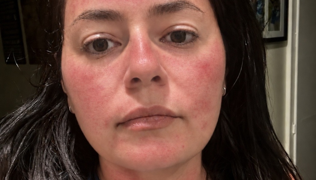 Close-up of a woman's face showing red skin inflammation and a rash across her cheeks and nose.