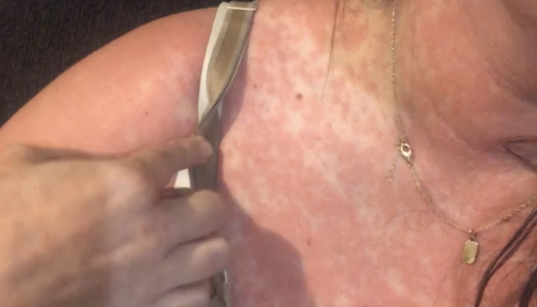Close-up of a widespread, red blotchy skin rash covering a person's chest, neck, and shoulder.
