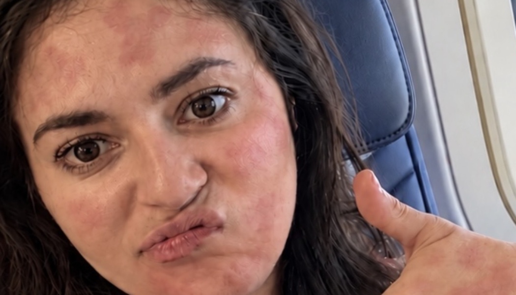 A woman sitting on an airplane gives a thumbs-up while showing a visible red skin rash across her face.