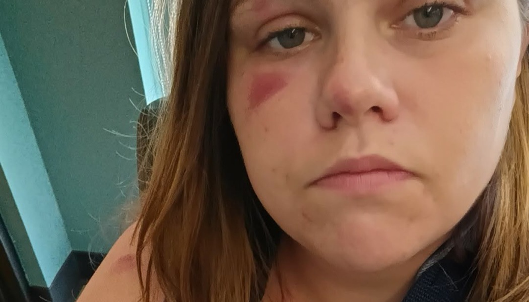 Close-up portrait of a woman with brown hair, featuring a noticeable red bruise under her right eye.