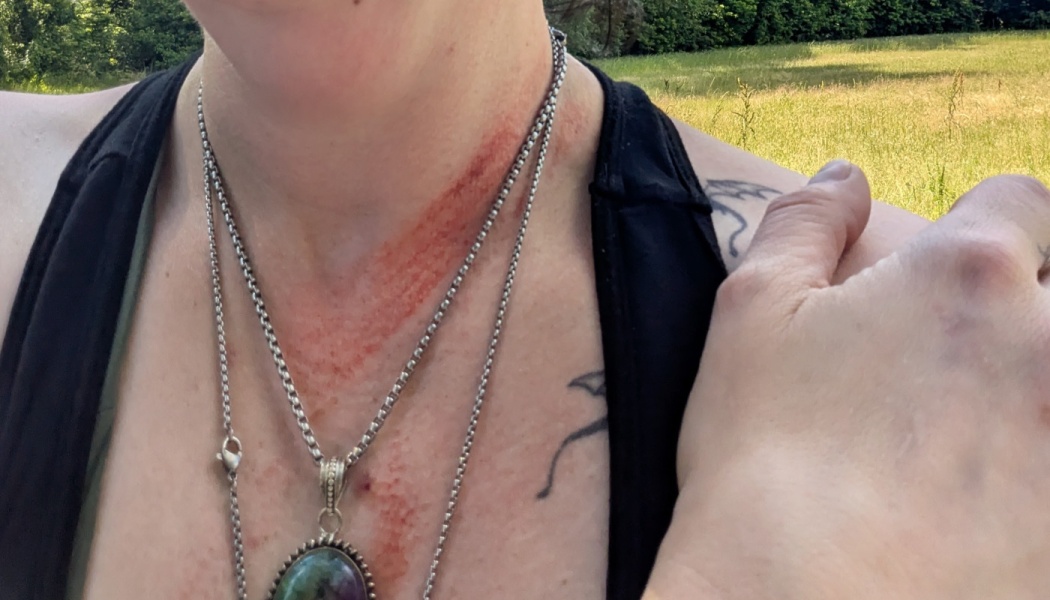Close-up of a person with a red scrape on their neck and collarbone, wearing silver chain necklaces.
