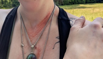 Close-up of a person with a red scrape on their neck and collarbone, wearing silver chain necklaces.