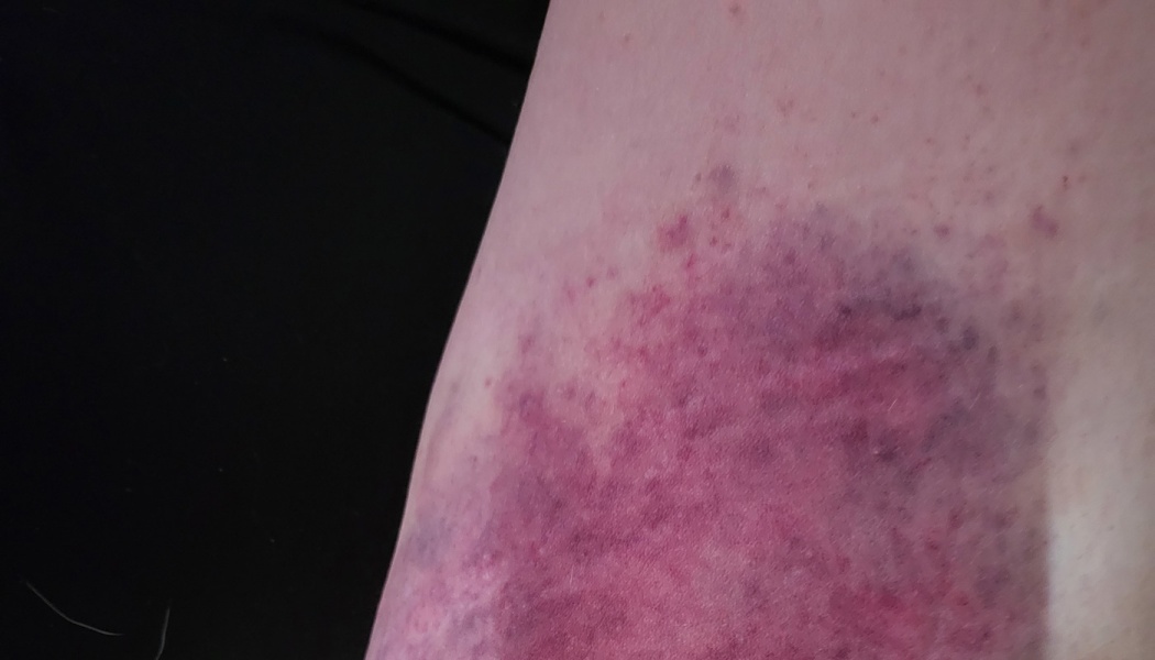 Close-up of a large, dark purple and deep red bruise on fair skin.
