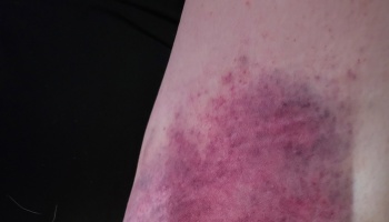 Close-up of a large, dark purple and deep red bruise on fair skin.