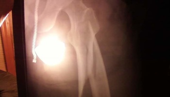 X-ray of a hip joint and upper femur bone, showing pelvic structure alongside a visible zipper from clothing.
