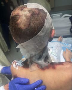 Lexi with Buzz Cut in Burn Unit so Medical Team Can Protect Her Skin