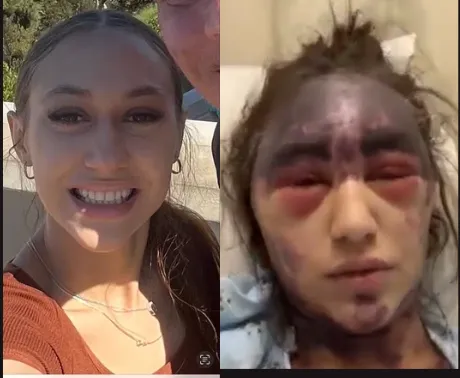 Alexis vaccine injury