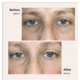 Auria Vita Solo - HomeMicrodermabrasion Machine-Fa