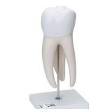 3B Scientific D15 Giant Molar w/ Dental Caries 15x life-size 6-part - 3B Smart Anatomy