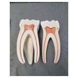 3B Scientific D15 Giant Molar w/ Dental Caries 15x life-size 6-part - 3B Smart Anatomy