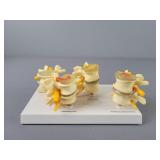 Gpi Anatomicals 4-stage Vertebrae Pathology Model