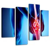 Canvas Wall Art Knee Painful Skeleton 4PANEL