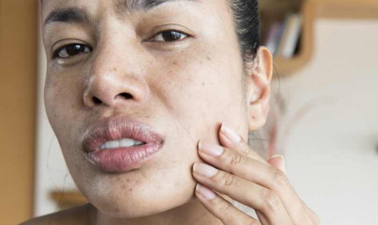 Does masturbation help acne