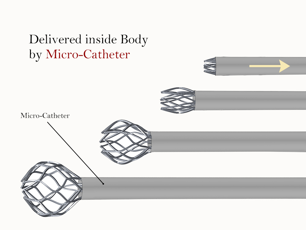 Spherical Occlusion Device,  | International Design Awards Winners