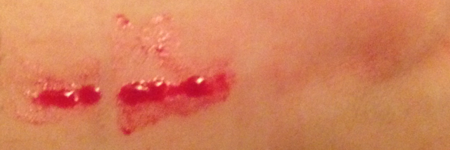 Cover image for post bloodsucker at large, by unspecific