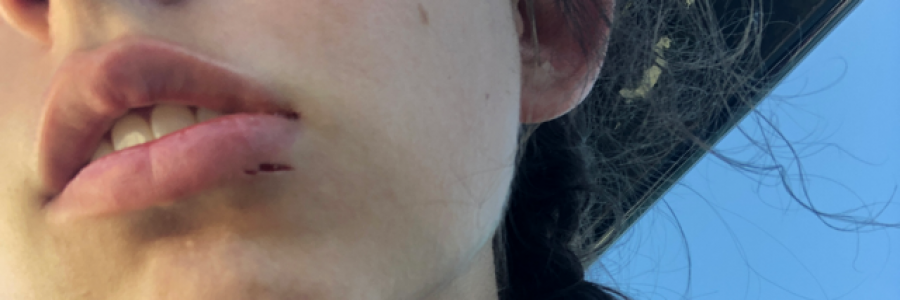 Cover image for post I sent my teeth through my lip, by Imnotawriter16