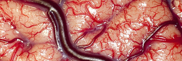 Cover image for post reasons why i watch neurosurgery videos on YouTube, by rml0418