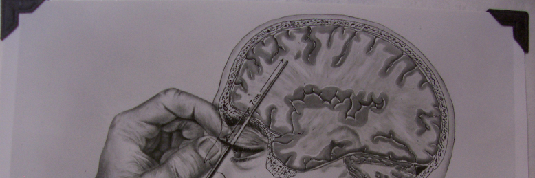 Cover image for post Lobotomy, by nfaulk6