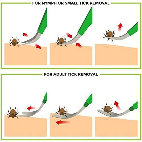 TickCheck Premium Tick Remover Kit