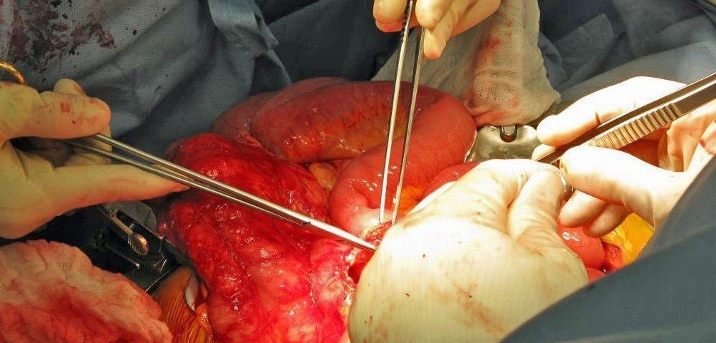 KPsurgery