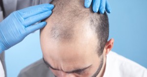 Most Asked Question Answered In India What is the Cost of Hair Transplantation05 25 28 1