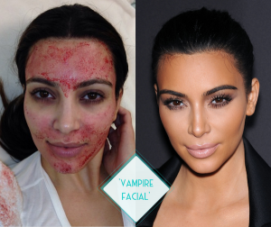 Facial PRP