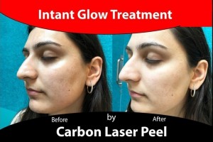 carbonlaserpeel