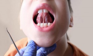 Frenectomy