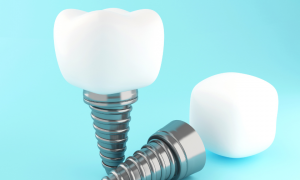 dental implant