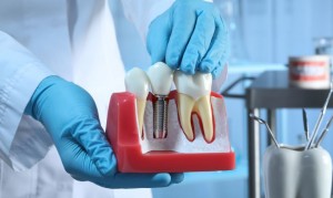 Dental implants in Salt Lake City, UT