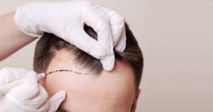 Panacea: Trusted Clinic And Appropriate Solution For Hair Loss and Regrowth