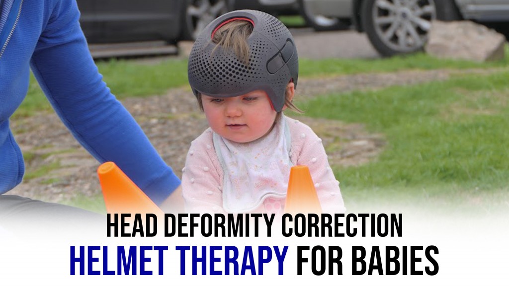 Hope AMC Helping Children with Effective Helmet Therapy for Correcting Head Deformities IssueWire