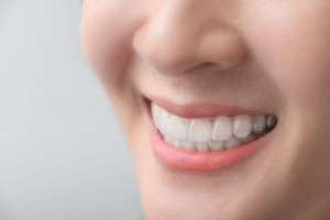 Invisalign in Overbite Correction scaled 1000x0 c default