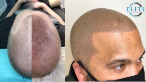 Scalp Micropigmentation - Before and After
