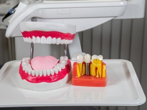 Press Release For Same Day Crowns Service