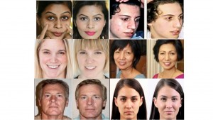 Master Esthetician and Wellness Practitioner Richard Haxton - Before and Afters