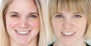 Winner Announced for Silicon Valley's Best Treatment For Non-Surgical Facial Rejuvenation