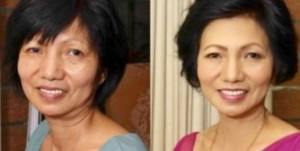 Winner Announced for Silicon Valley's Best Treatment For Non-Surgical Facial Rejuvenation