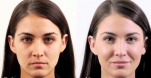 Winner Announced for Silicon Valley's Best Treatment For Non-Surgical Facial Rejuvenation