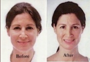 Winner Announced for Silicon Valley's Best Treatment For Non-Surgical Facial Rejuvenation