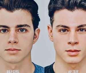 Winner Announced for Silicon Valley's Best Treatment For Non-Surgical Facial Rejuvenation