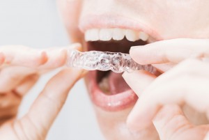 Invisalign 4 scaled
