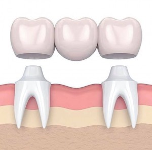 Dental Bridge