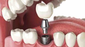 Dental Crown and Dental Implant
