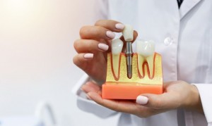 dental implants gilbert 2