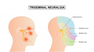 17479715 trigeminal neuralgia 1 1536x847